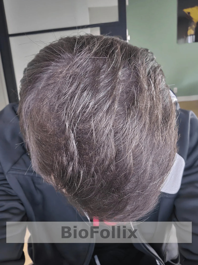 Top view of thick, healthy hair on scalp three years after hair restoration treatment.