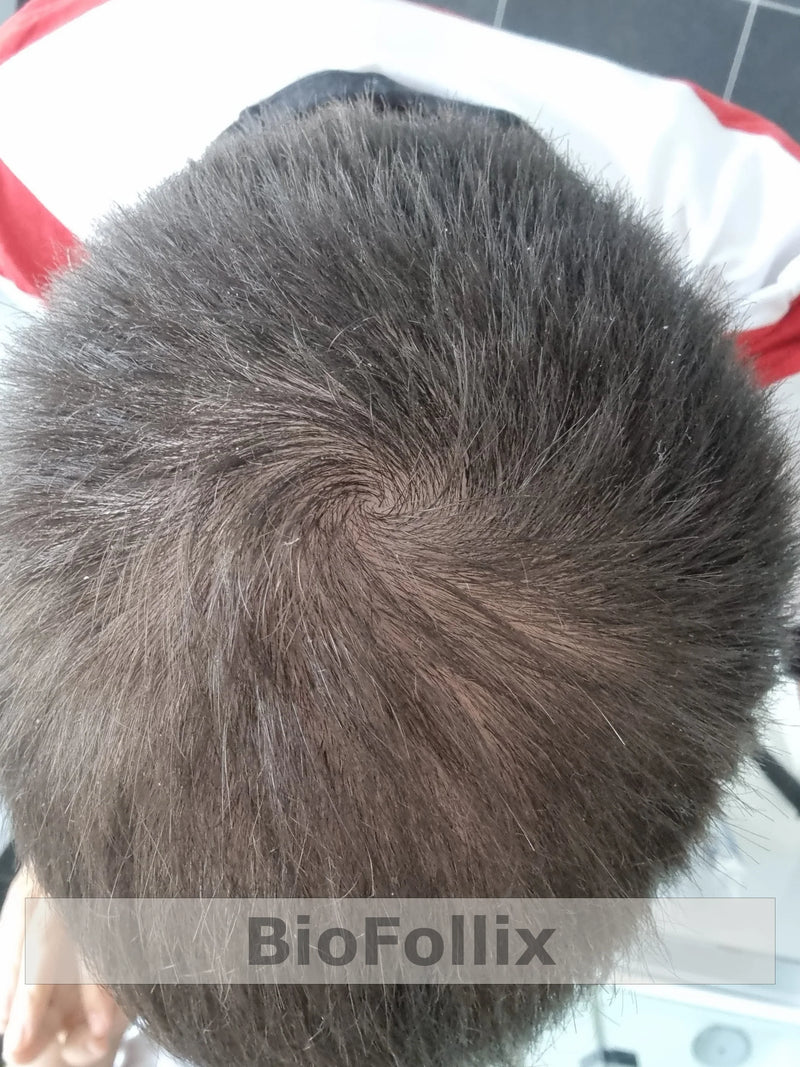 Top view of healthy, dense hair growth on scalp three months after treatment