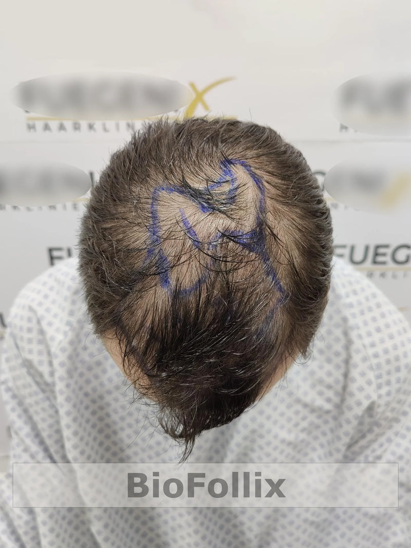 Man with thinning hair and marked scalp for hair transplant consultation